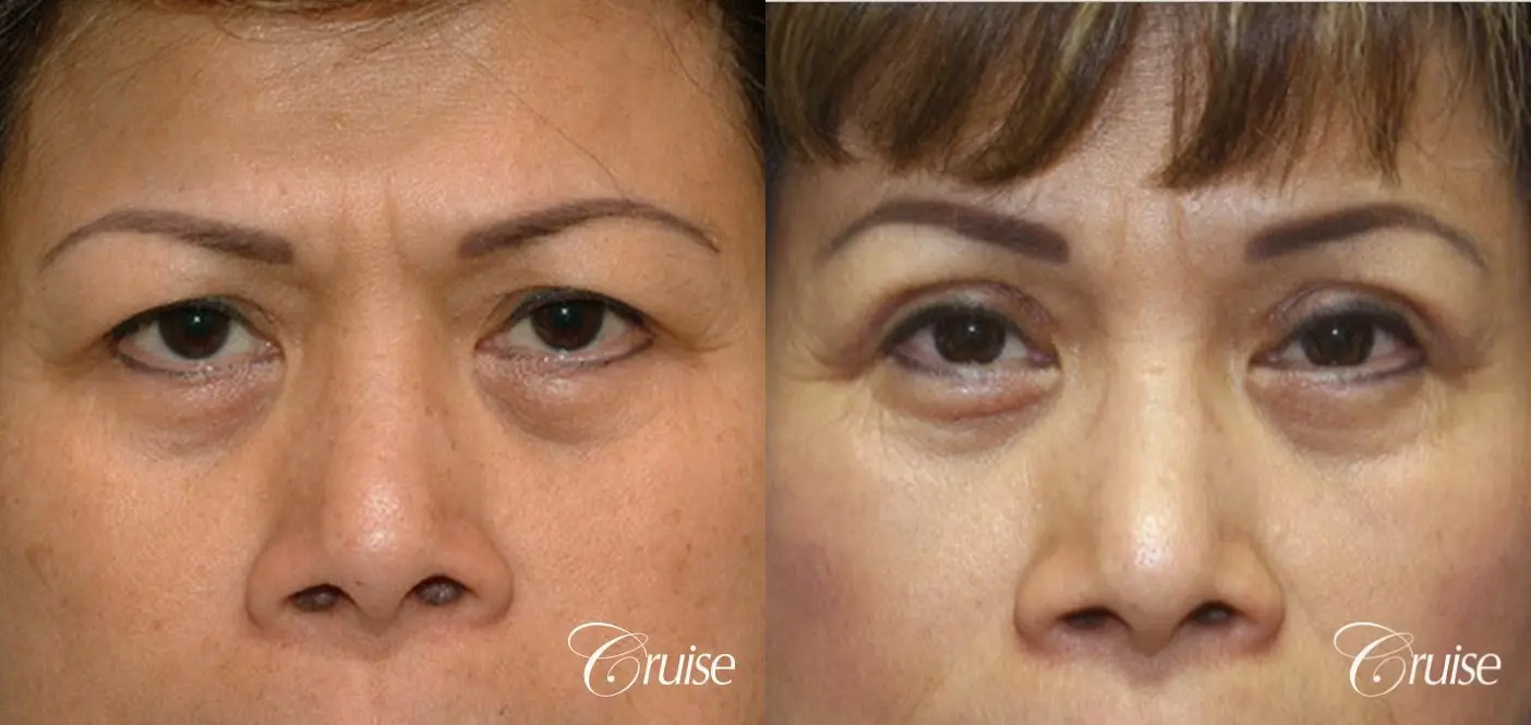 best Asian Upper eye lid plastic surgeon Newport Beach - Before and After
