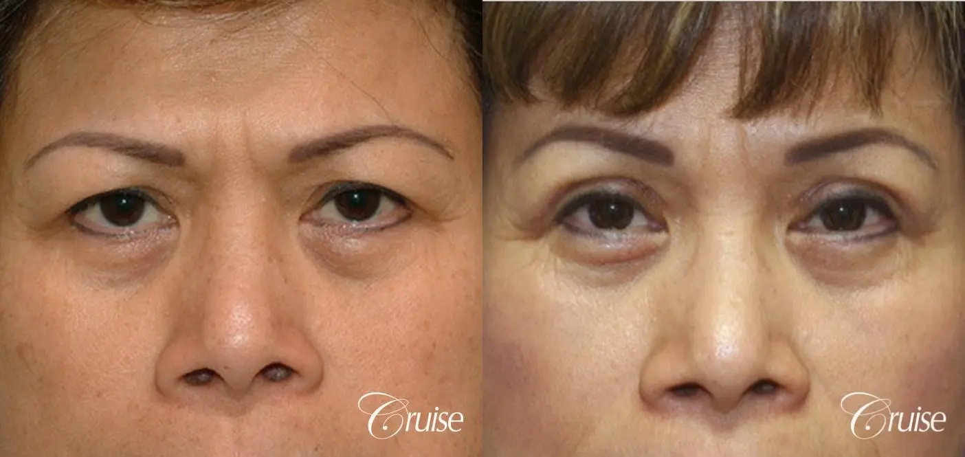 best Asian Upper eye lid plastic surgeon Newport Beach - Before and After 1