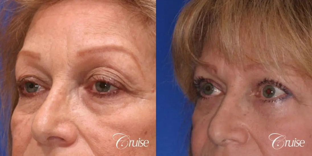 best upper eyelid plastic surgeon - Before and After 1