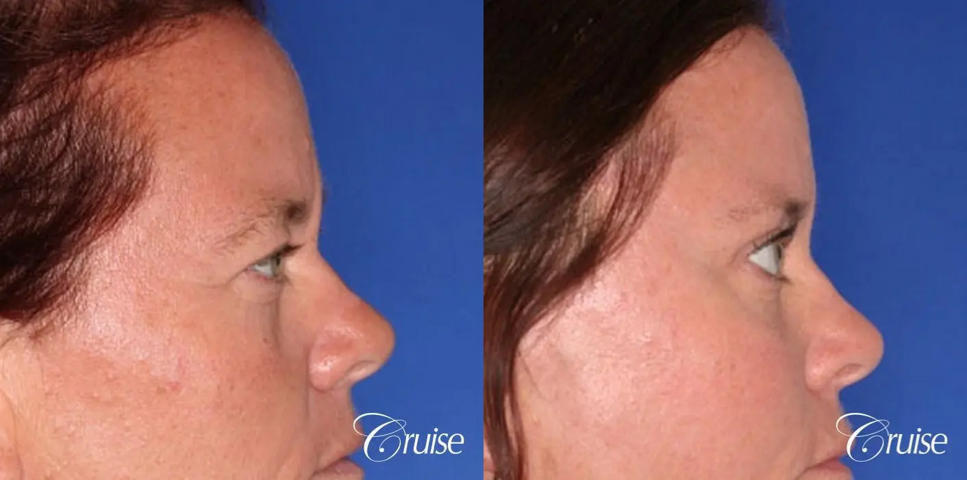best results for upper blepharoplasty - Before and After 4