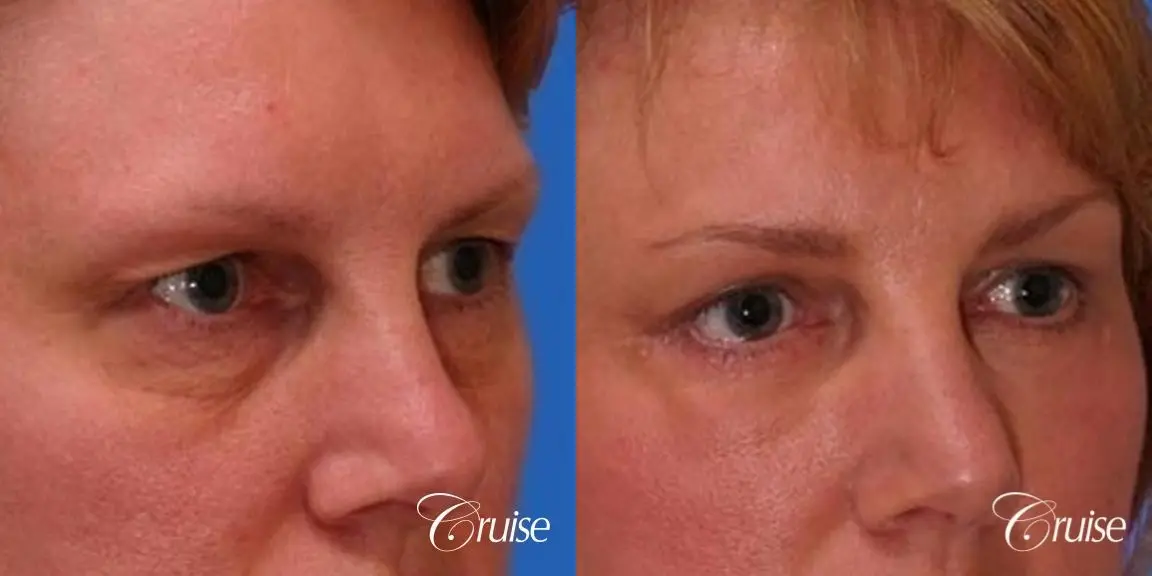 best review on upper eyelid plastic surgeon - Before and After 3