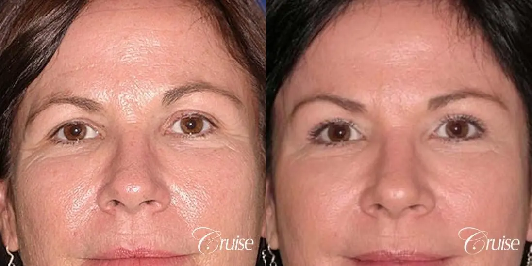 best plastic surgery on upper eyelids - Before and After