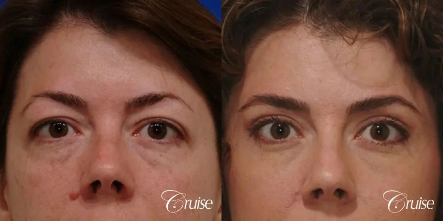 Blepharoplasty - Upper and Lower - Before and After  