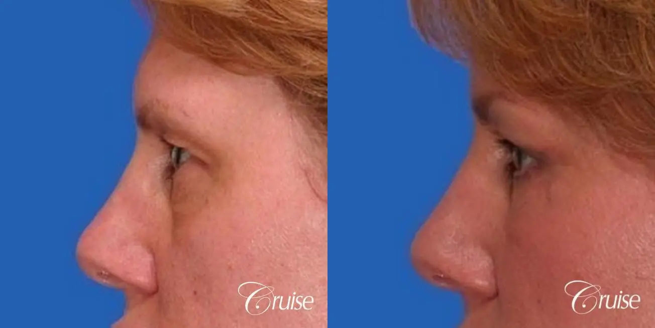 best review on upper eyelid plastic surgeon - Before and After 2