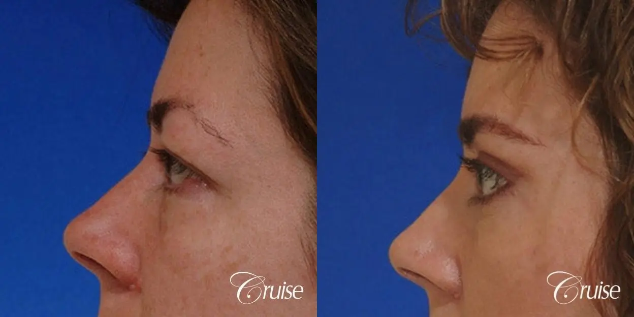 blepharoplasty specialist - Before and After 2