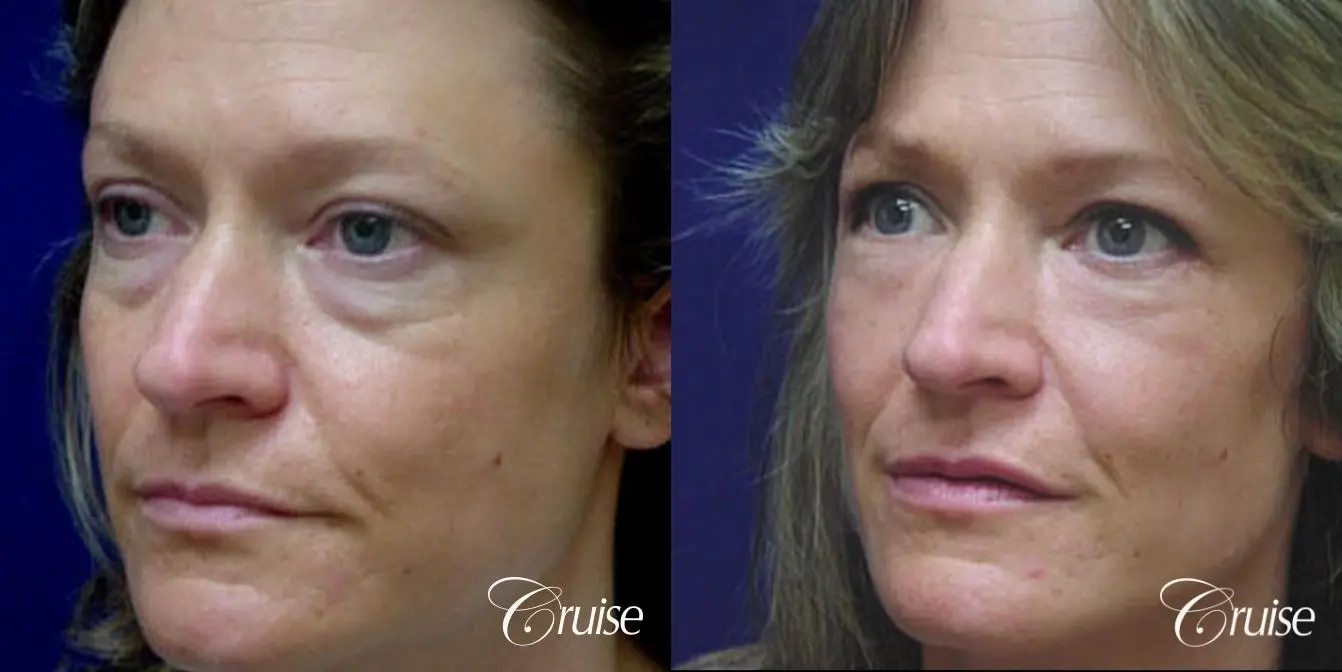 Blepharoplasty - Lower - Before and After 2