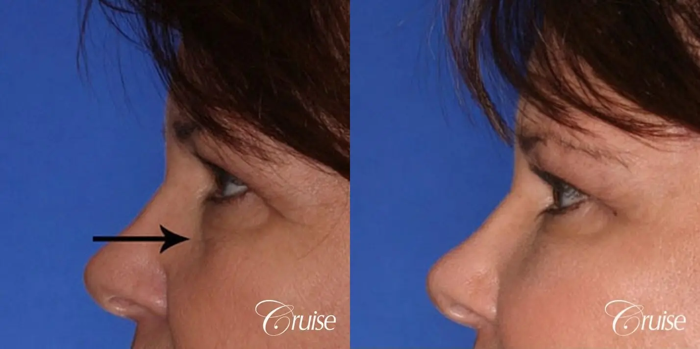 Blepharoplasty - Lower - Before and After 1