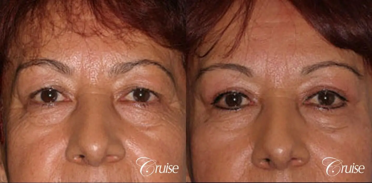 upper eyelid rejuvenation pictures - Before and After 1