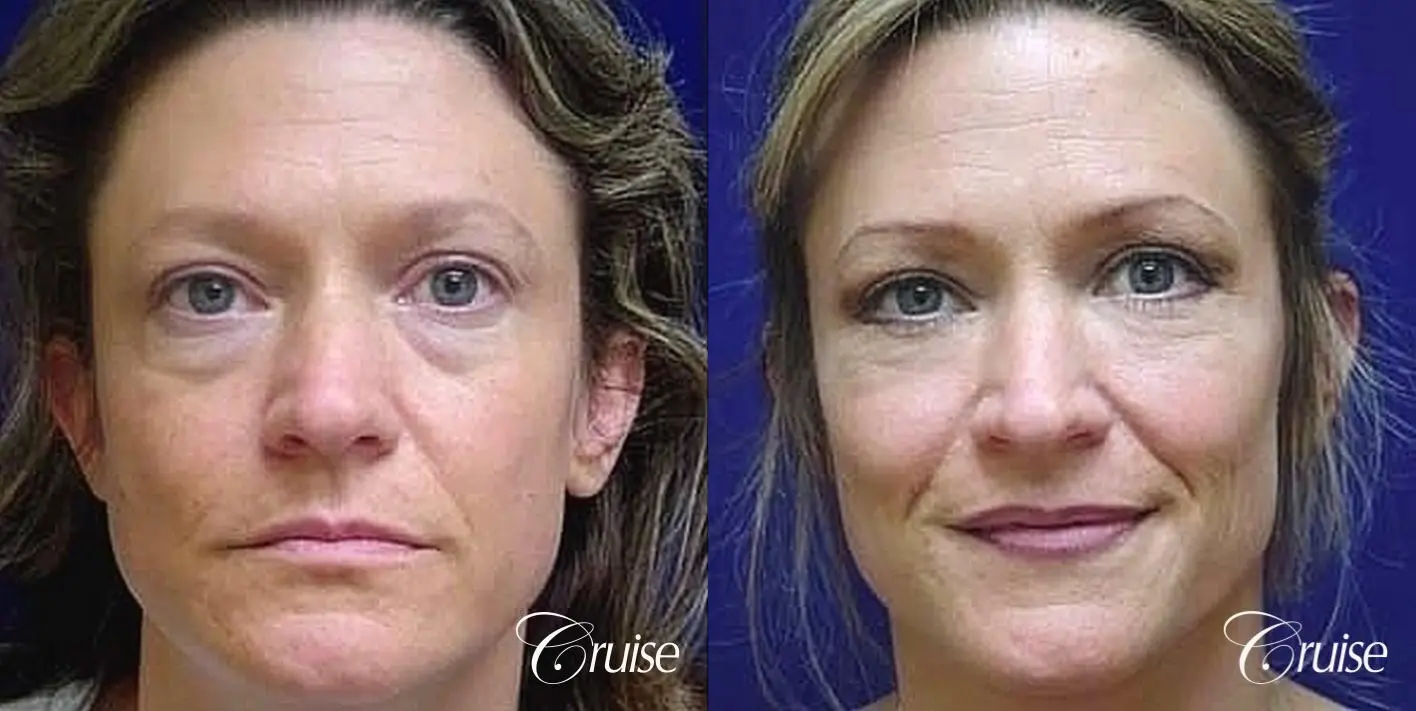 Blepharoplasty - Lower - Before and After  