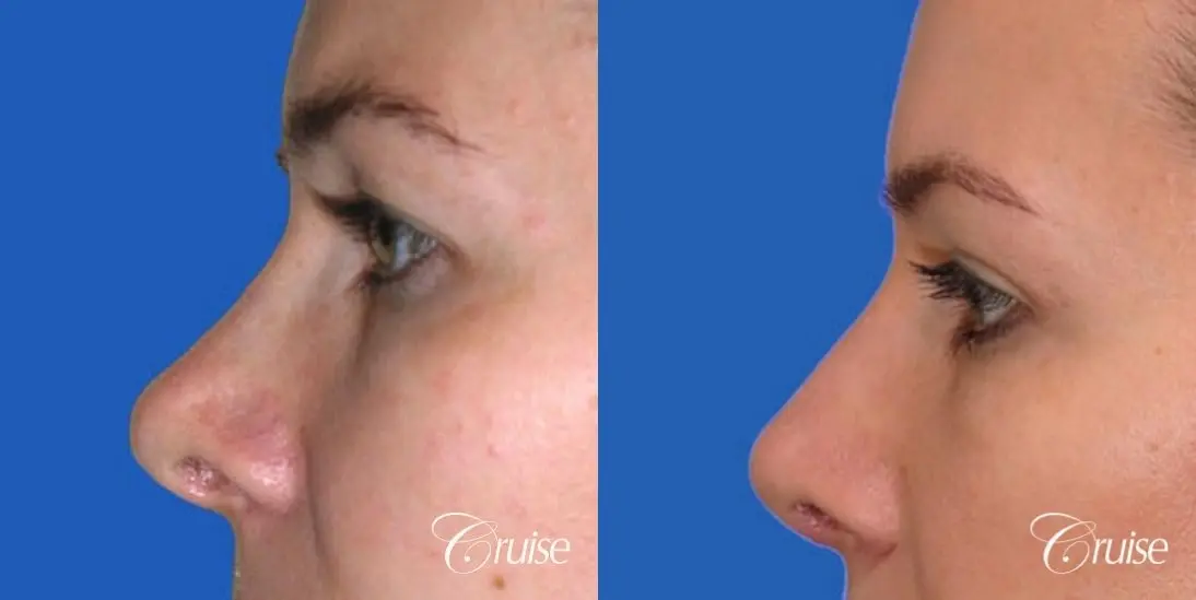 best before and after pictures of upper eyelid surgery - Before and After 2