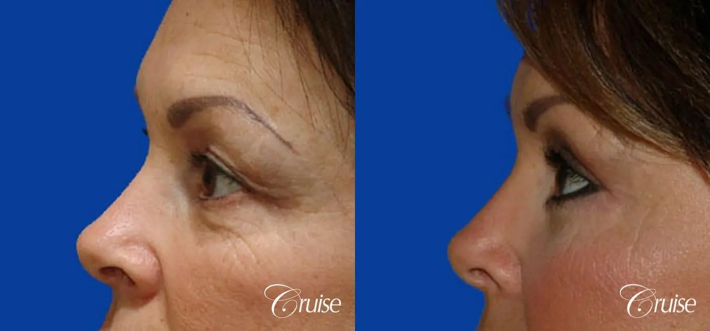 best blepharoplasty eye surgery photos - Before and After 2