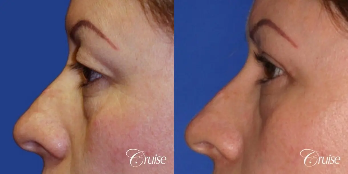 recovery on blepharoplasty - Before and After 2