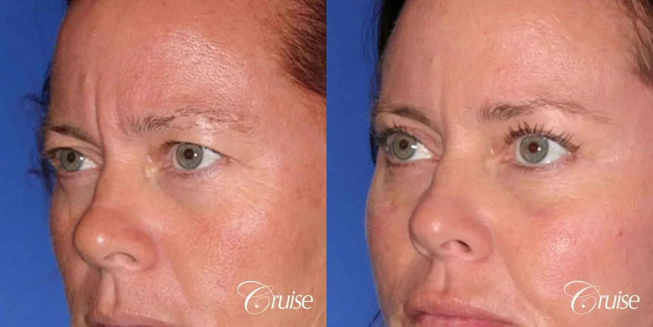 best results for upper blepharoplasty - Before and After 3