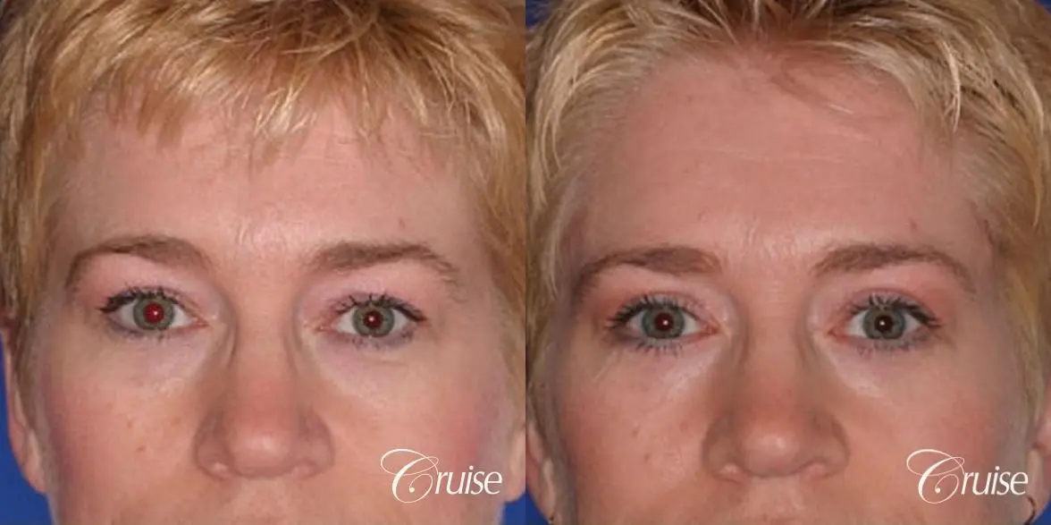 best specialist for upper eyelid surgery - Before and After