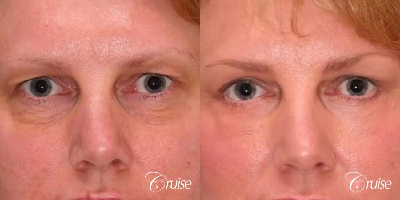 best review on upper eyelid plastic surgeon - Before and After 1