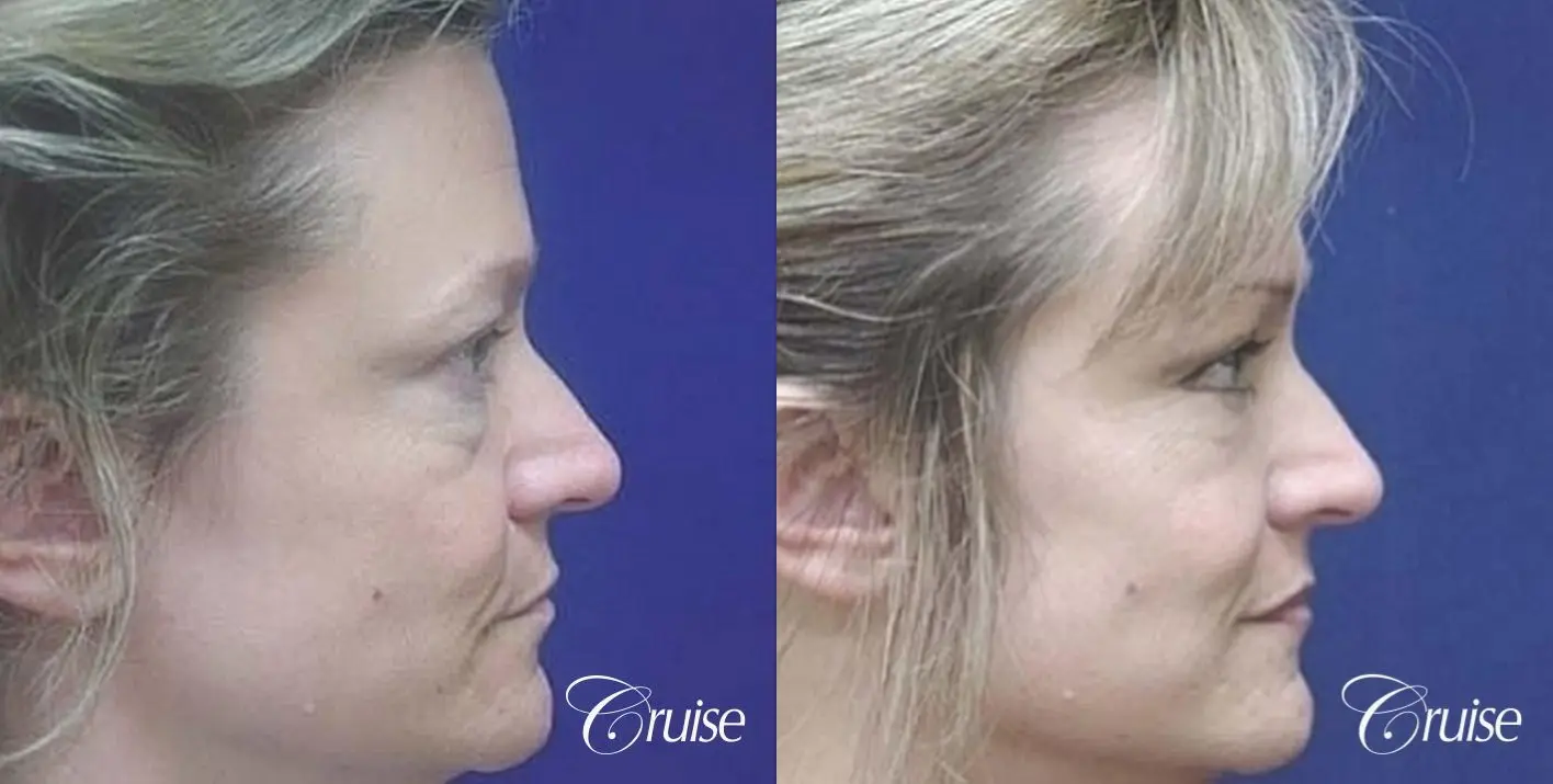 Blepharoplasty - Lower - Before and After 3