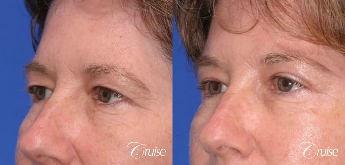 natural upper eyelid surgery - Before and After 3