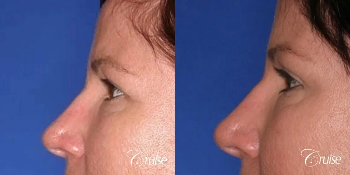 best plastic surgery on upper eyelids - Before and After 2