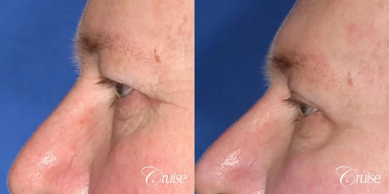 male with upper eye lid surgery pictures - Before and After 2