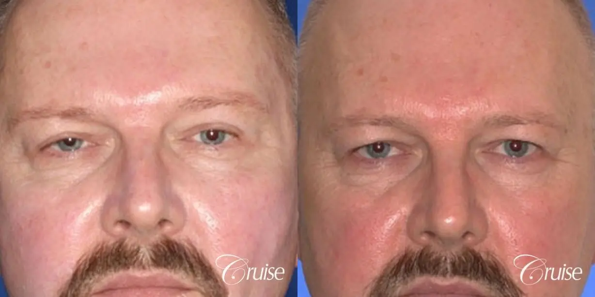 male with upper eye lid surgery pictures - Before and After 1