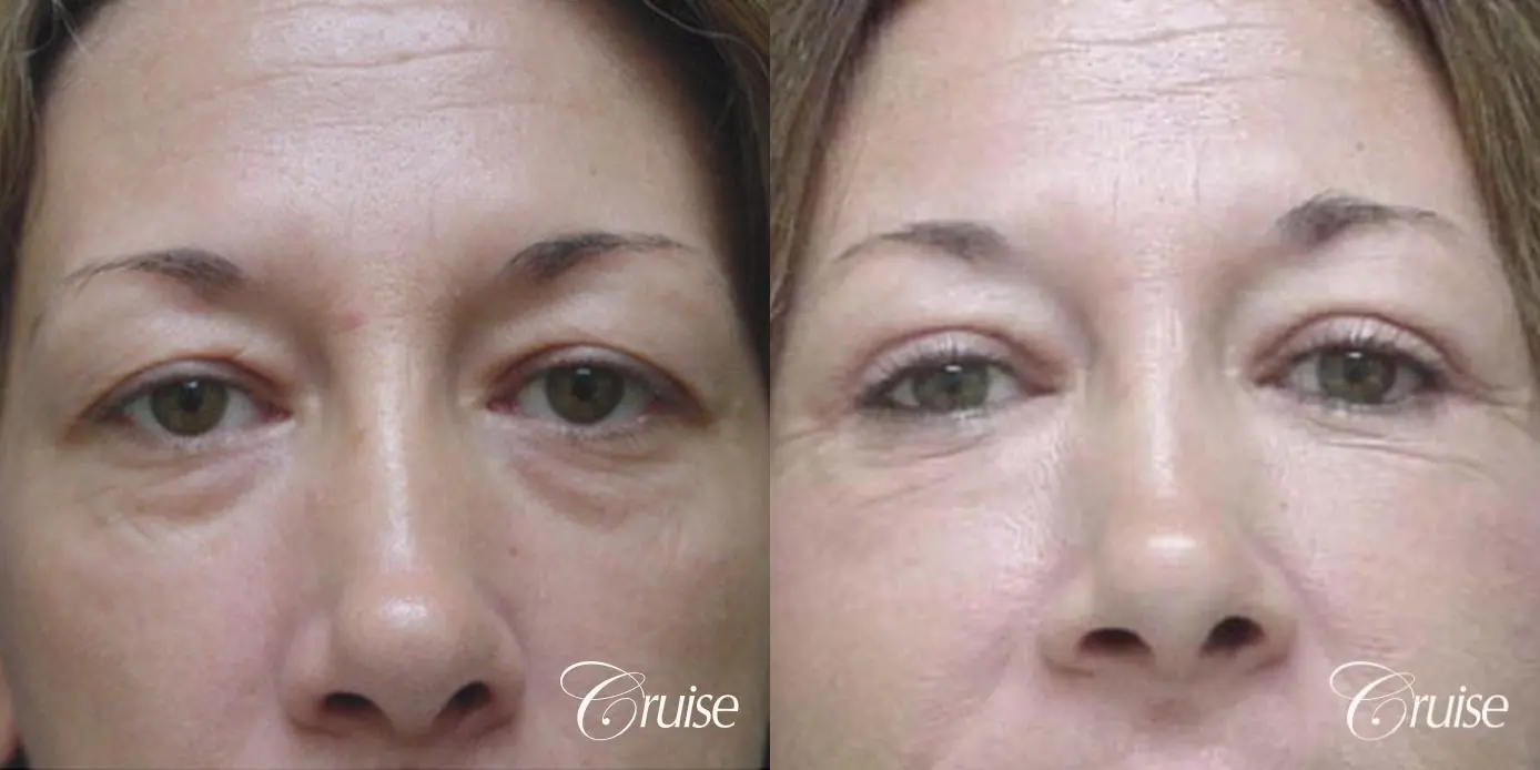 Blepharoplasty - Upper and Lower - Before and After 1