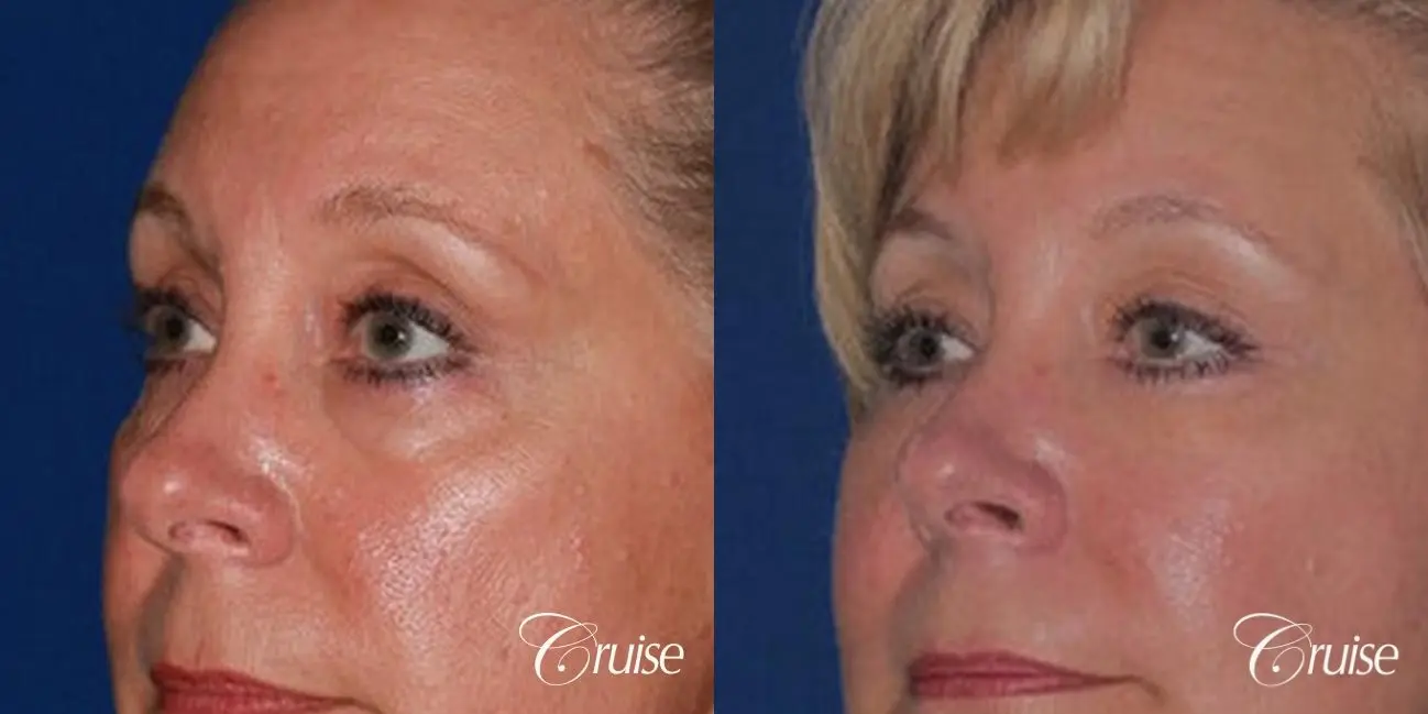 Blepharoplasty - Lower - Before and After 2