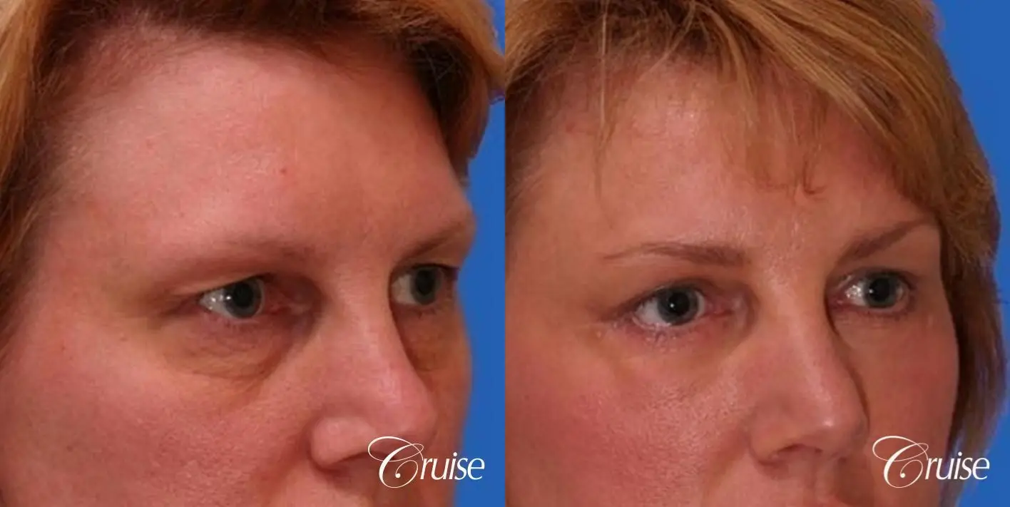 Blepharoplasty - Lower - Before and After 3