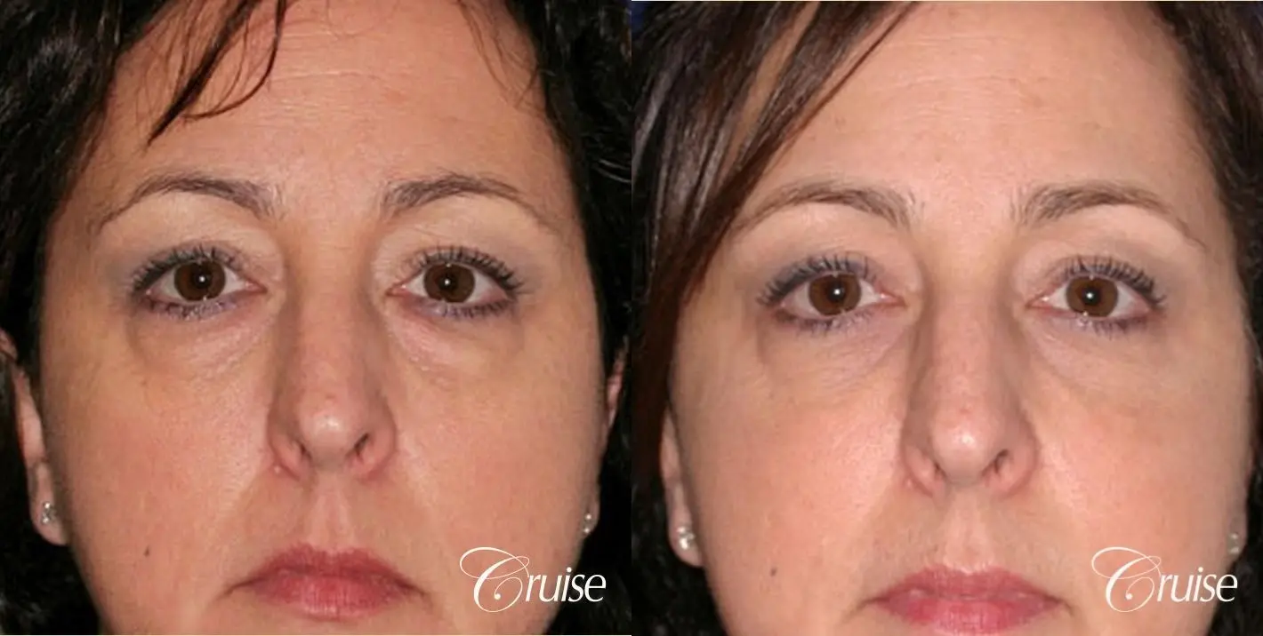 Blepharoplasty - Lower - Before and After 1