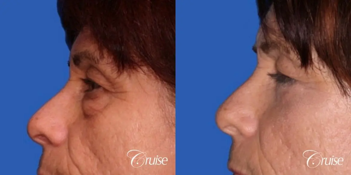 Blepharoplasty - Lower - Before and After 3