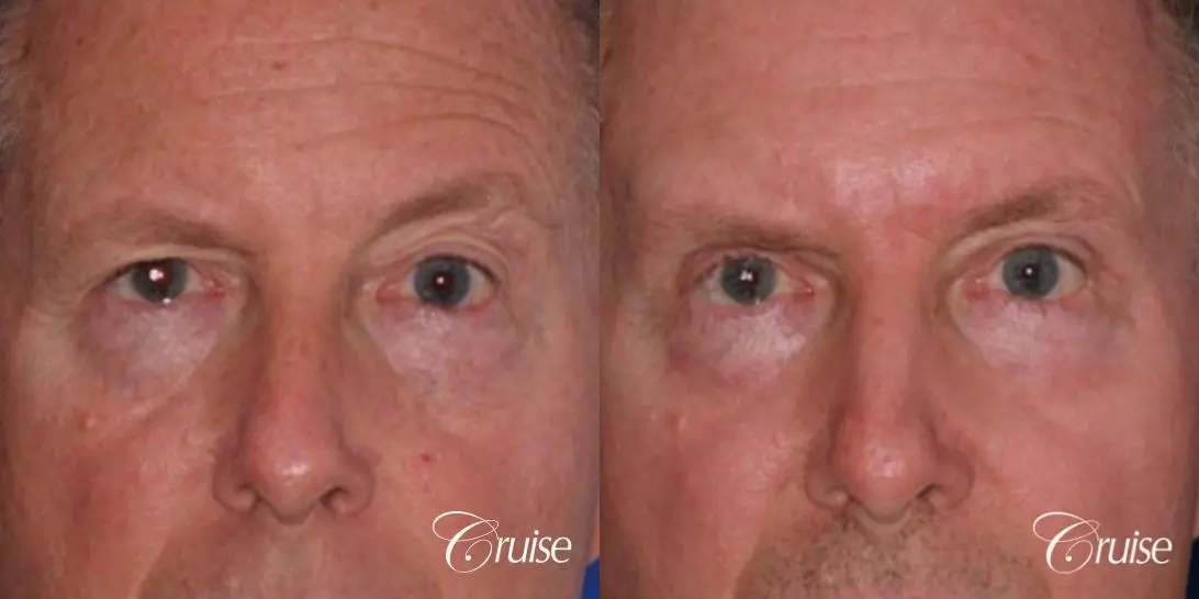 best upper eyelid surgery on a male patient - Before and After 1