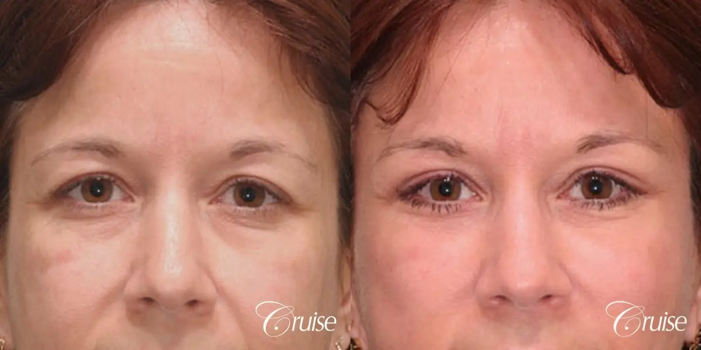 Blepharoplasty - Upper and Lower - Before and After 1