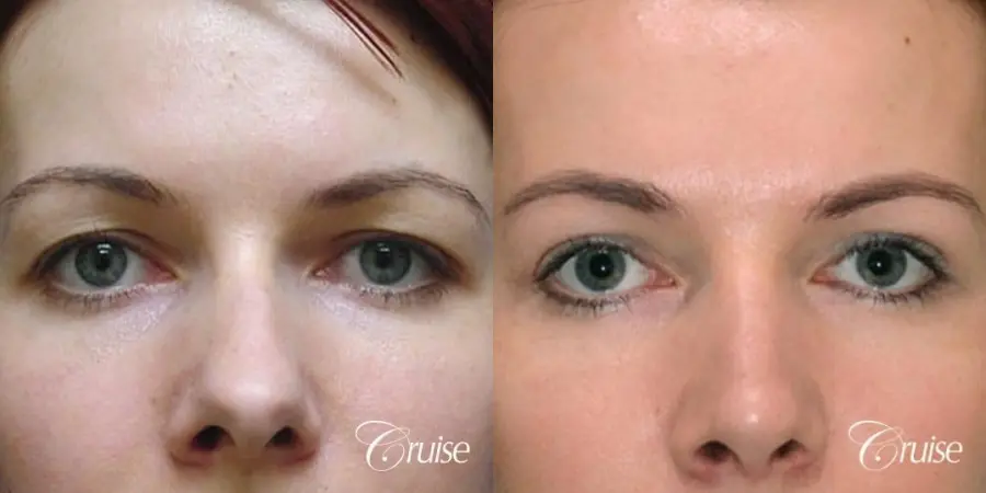 best before and after pictures of upper eyelid surgery - Before and After