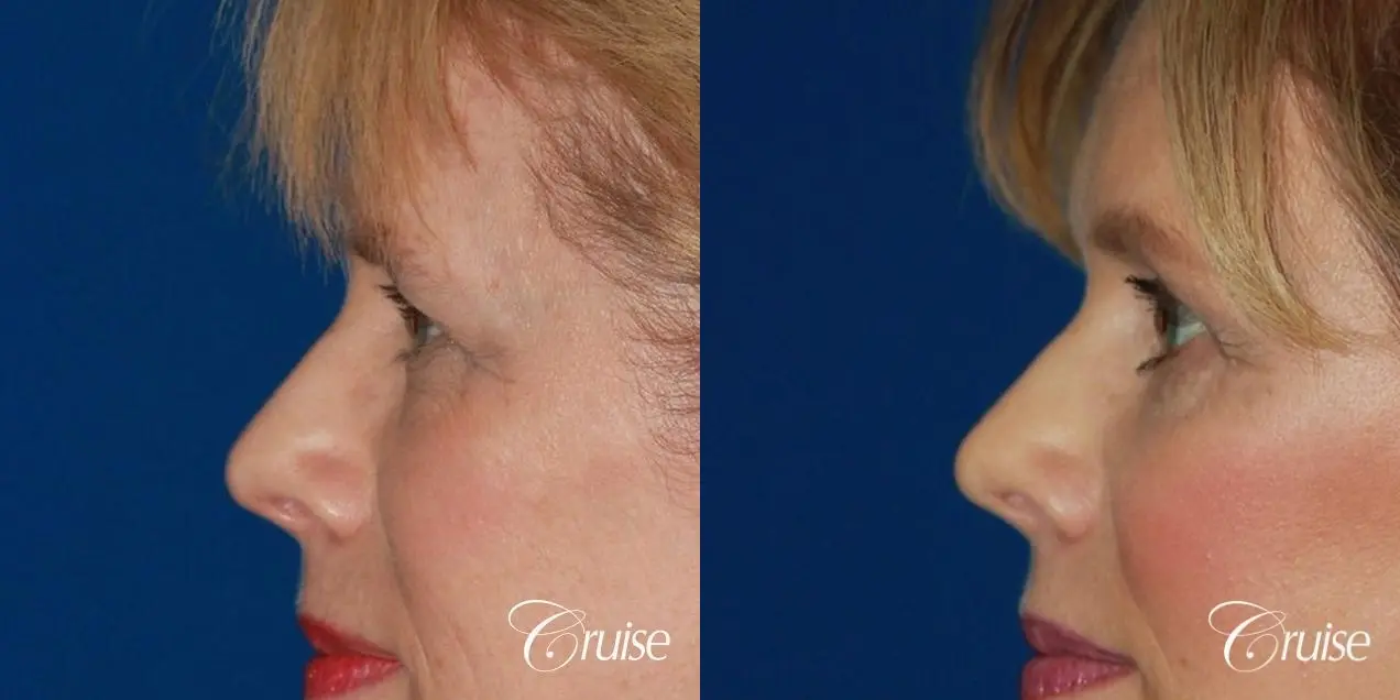 facelift with upper blepharoplasty - Before and After 2