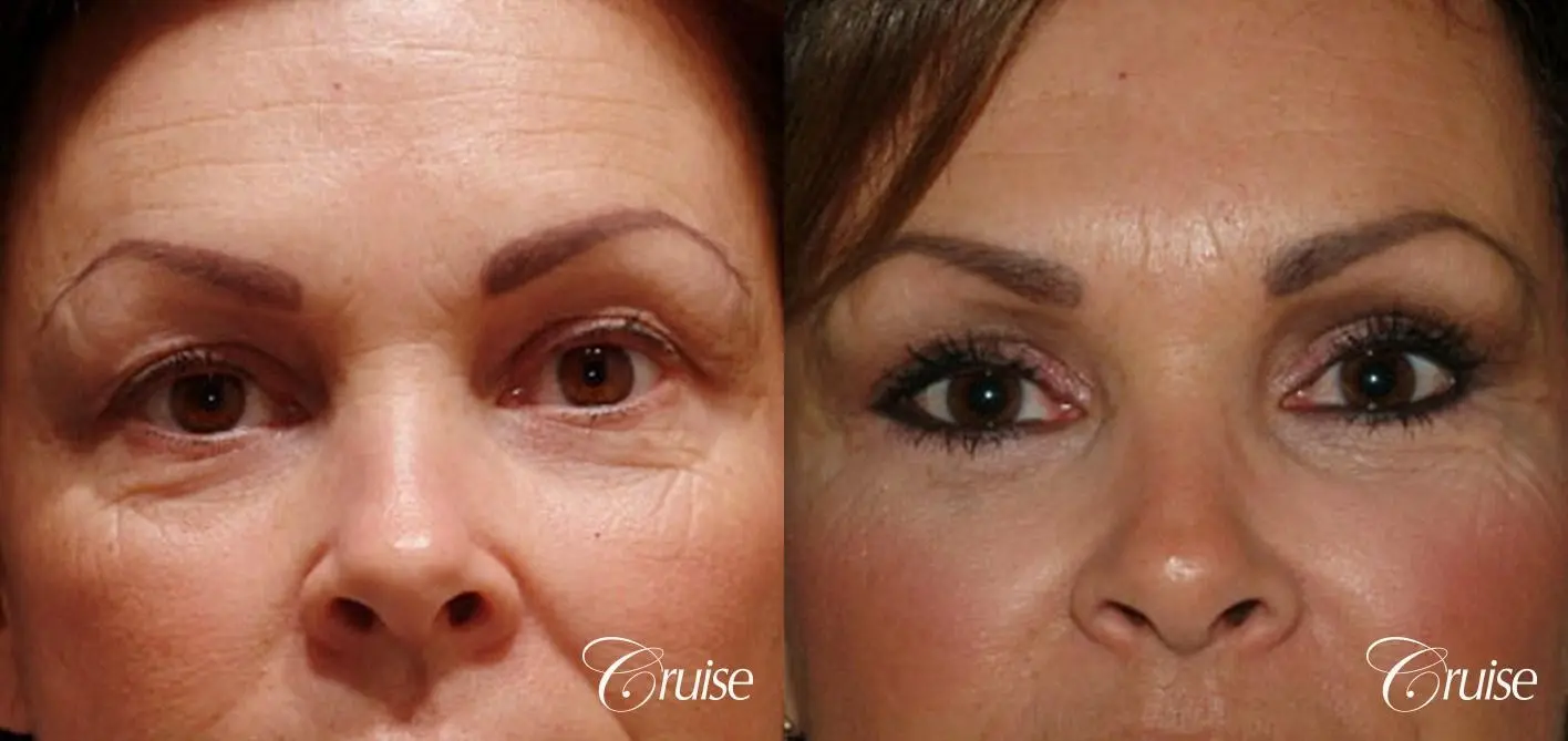 best blepharoplasty eye surgery photos - Before and After