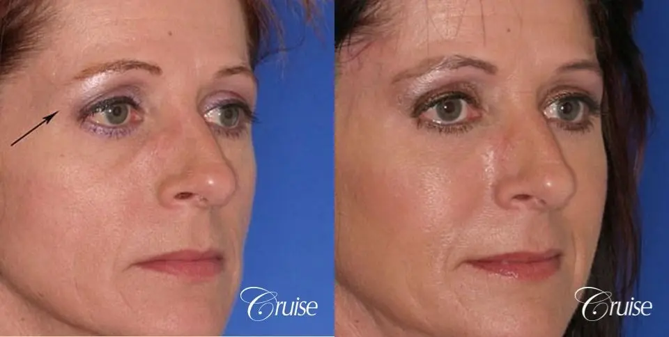 Blepharoplasty - Lower - Before and After 3