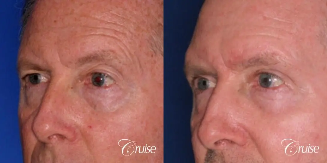 best upper eyelid surgery on a male patient - Before and After 2