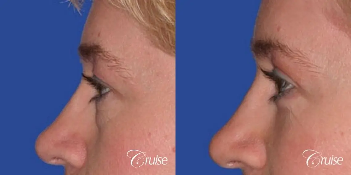 best specialist for upper eyelid surgery - Before and After 2