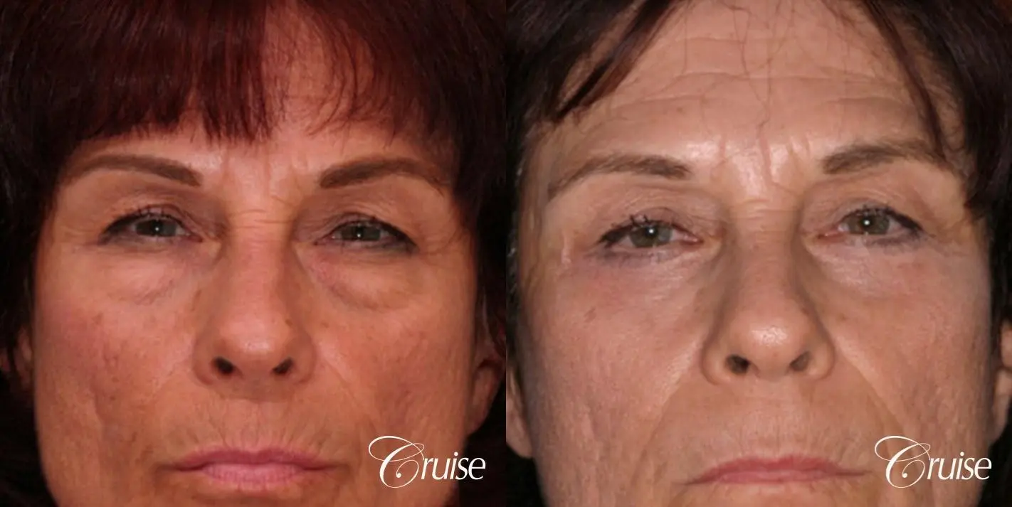 Blepharoplasty - Lower - Before and After 1
