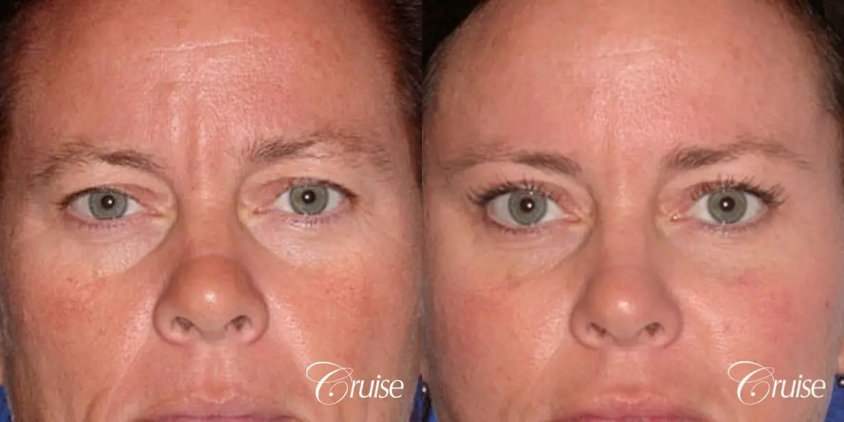 best results for upper blepharoplasty - Before and After 1