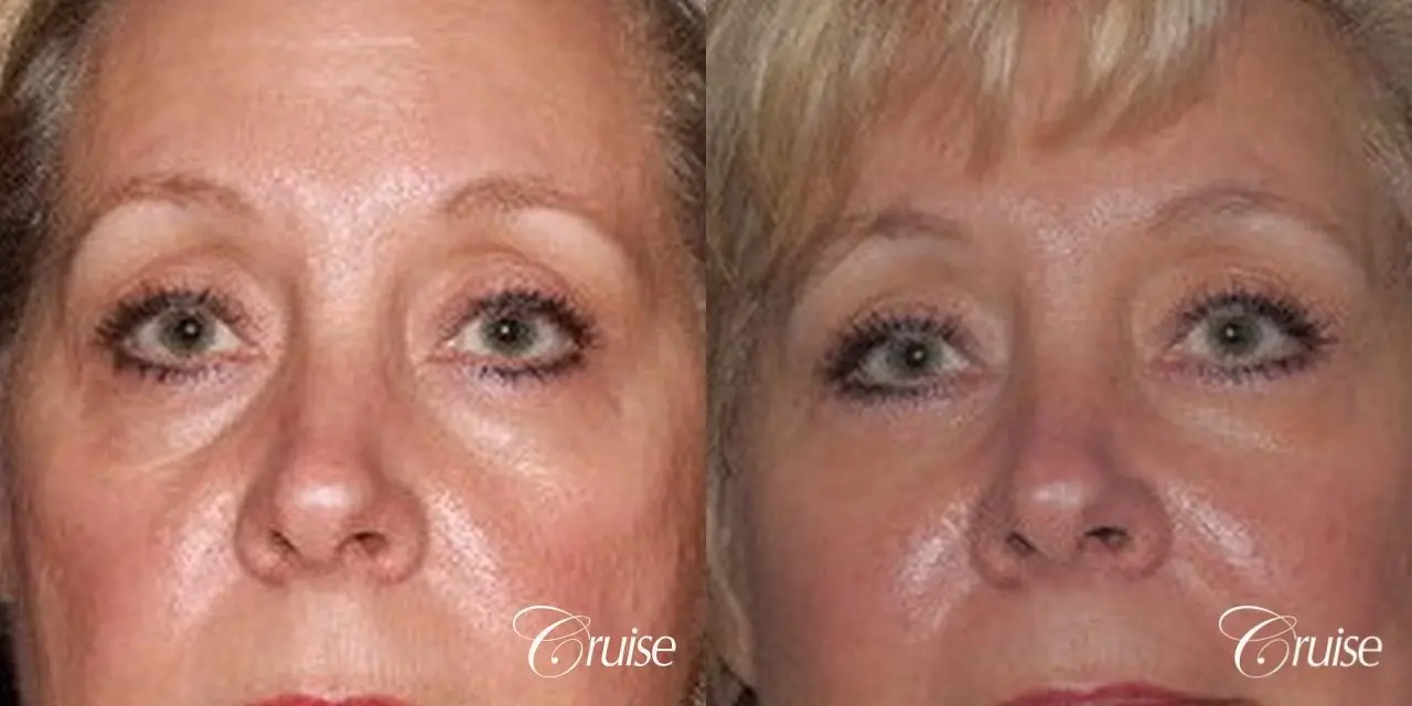 Blepharoplasty - Lower - Before and After 1