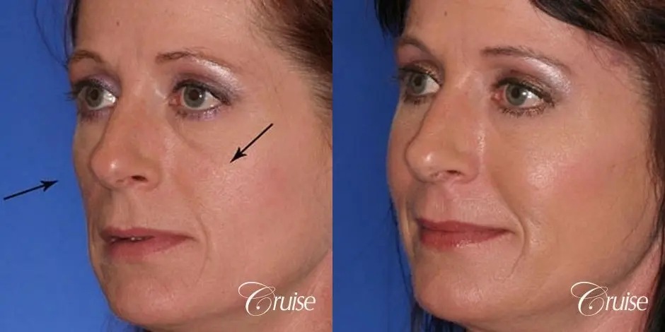 Blepharoplasty - Lower - Before and After 2