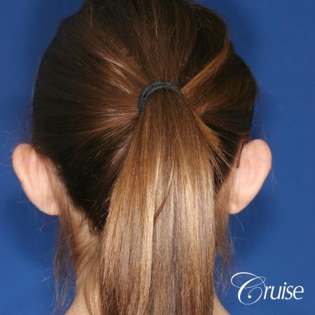 best before and after pictures of otoplasty - Before and After Image 2