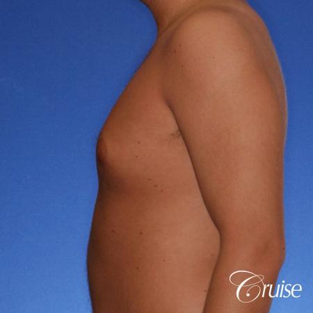 best puffy nipple gynecomastia results with plastic surgeon, Joseph Cruise, M.D. - Before Image 2