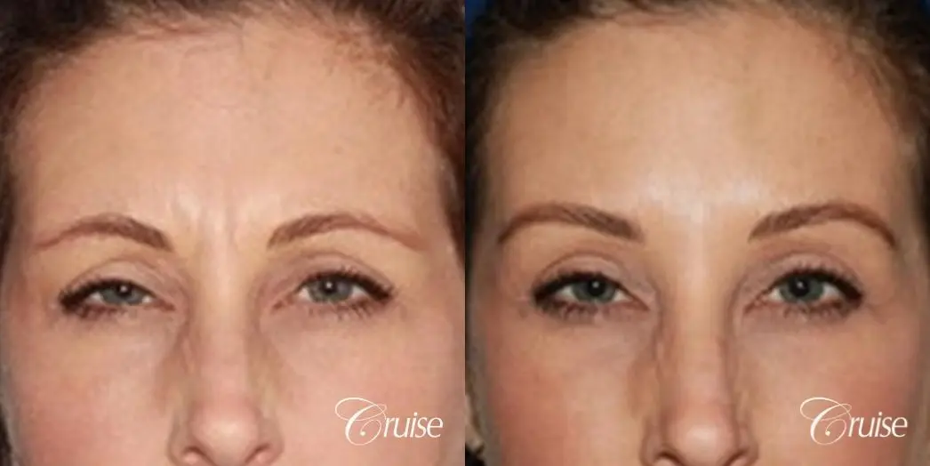 best botox results that look natural newport beach - Before and After