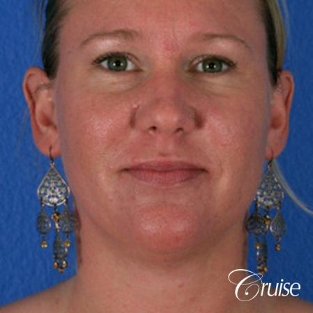 best liposuction neck and jawline for double chin - After Image