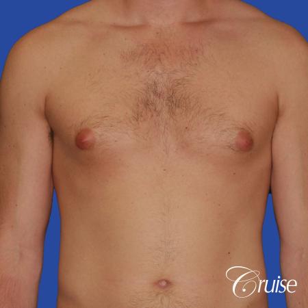 young adult with puffy nipple gets the best results with top gynecomastia surgeon - Before Image 1