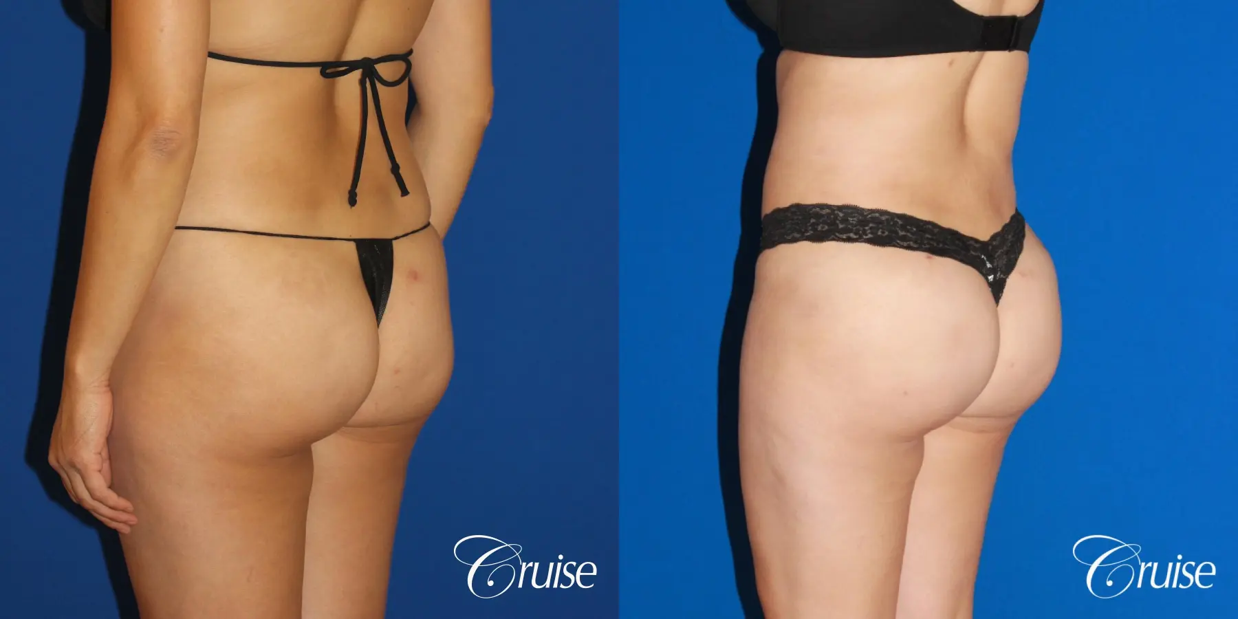 Brazilian Butt Lift, Lipo Flanks and Thighs - Before and After 2