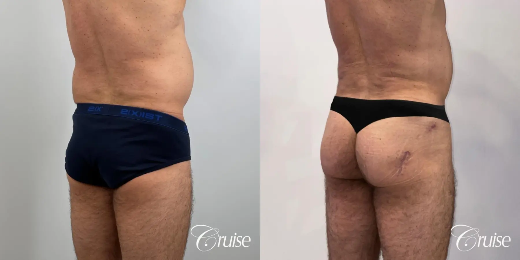 Brazilian Butt Lift: Patient 24 - Before and After 4