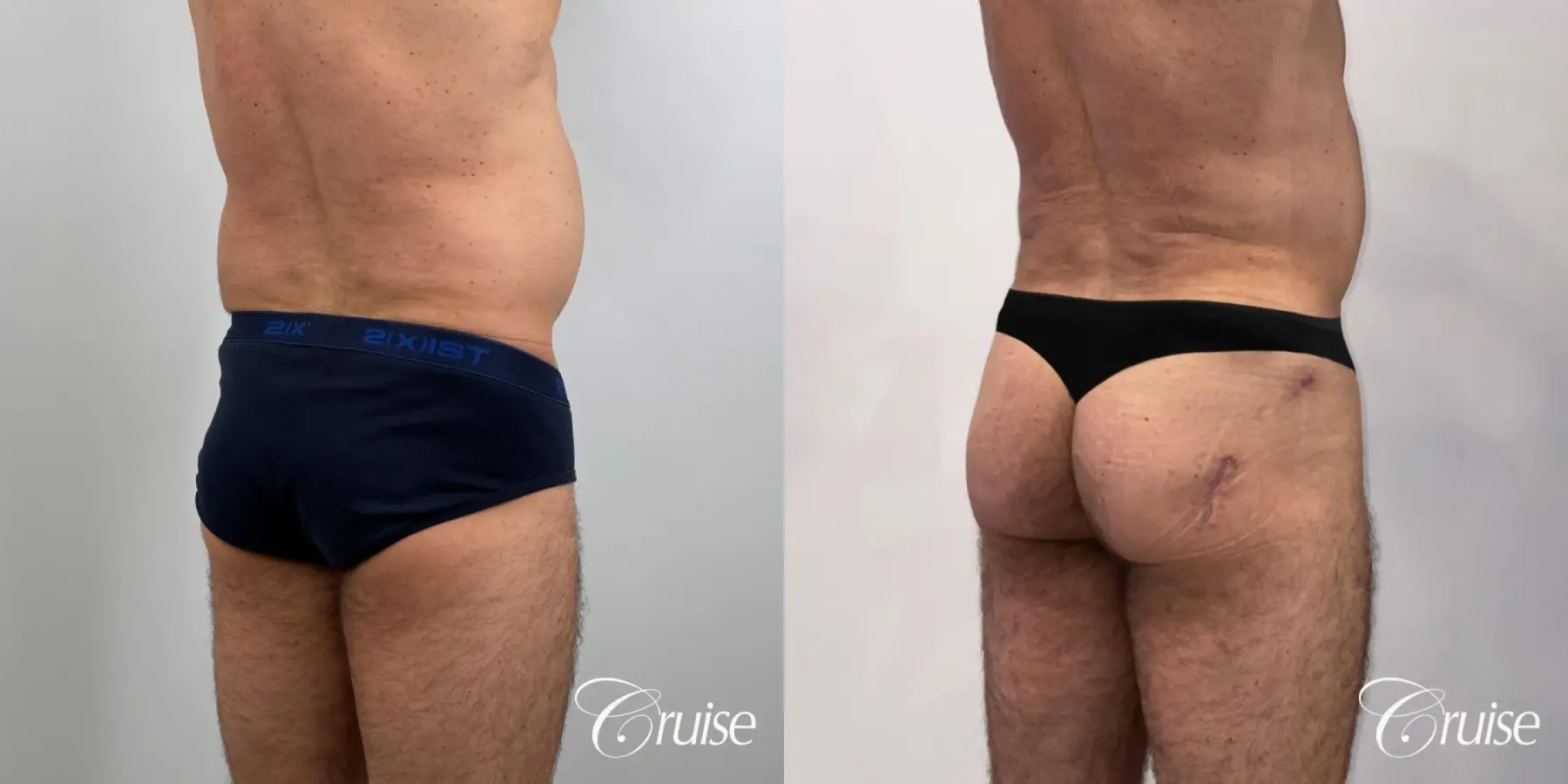 Brazilian Butt Lift: Patient 26 - Before and After 4