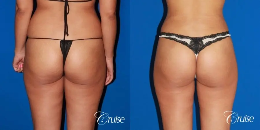 best bbl before and after pictures orange county - Before and After